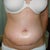 one week post surgery