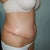 one week post surgery