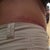 6 Months Post-op right side. Scar shows above pant line - Praying it turns white soon