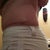 6 months post-op left side