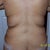 5 days post-op back