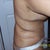 5 days post-op side view