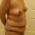 pre-op side view
