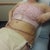 At the Dr. Post op Day 5