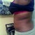 Side view 2 weeks Post op More Strecth Marks lol