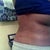 ha ha you can see my little marks but back view 2weeks post op