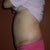 5 weeks PO, My hematoma is improving (that protruding area above my bellybutton).  You can also see the swelling in my lower abdomen by my incision (or at least I hope it is swelling and not loose skin).