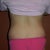 5 weeks PO, you can see my love handles that stick out when I wear low-cut underwear.  This is probably what bothers me the most.