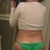 18 DAYS POST OP