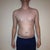 One week before smart lipo. Front Belly.