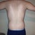 One week before smart lipo. Back pic.
