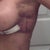 Yeah..there is the right side again! If it weren't for this, I could wear some cute clothes now!! You can see that the bruising is also the imprint of my sports bra!!