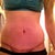 my incision one week post-op