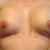 Calling this day 3 pic (since I got it done morning of the 27th).  I little bruising on my right breast.