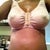 8 days post op sooo swollen.. boobies still tough sorta