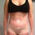 2 weeks post op - belly button plug - swelling or just not enough fat taken out?? legs look the same as i started