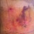 Post op 2 weeks - Bad Bruising!