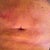 Post op 2 weeks Bad bruising!
