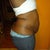 Side tummy tuck pre-op view!
