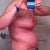 22 days post op - side view
