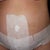Day 4 post-op