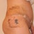 day 7 right side view.  bruising from the lipo.