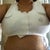 with post-surgical bra.  a bit of bleeding around nipple stopped.