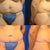 Before and 6 months post of my stomach