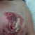 my wound was left to get like this