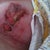 deteriorating wound