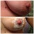Just really want to point out the difference, look at that mole.. So much lift!