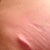 My scar dog eared as it healed. This wil be fixed early May.