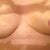 2 weeks post op