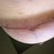 12 Weeks PO - Left breast scar