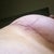 12 Weeks PO - Right breast scar