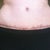 12 Weeks PO - TT scar