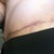12 Weeks PO - TT scar, left side