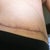 12 Weeks PO - TT scar, right side