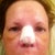 Day 5--most lower jaw swelling