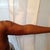 Arms 3 day postOp...My back looks like a train track but all is well. I am satisfied!