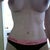 3 weeks post op. You can see the swelling in the middle.