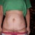 You can see the upper sag from the pregnancy!