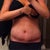 3 week po at the end of the day. PS calls the area from bb down to incision the "Flap". He says that I could expect swelling below the Flap from now to possibly off and on 3-6 months.. I am getting a smaller garment next week to press in more. So we'll see if it helps the "Flap" area :)