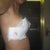 right side post op day 4, a little leakage/bleeding but nothing to worry about