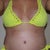 7 weeks post-op