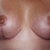 7 weeks post-op...Still need more healing under each breast.