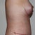 7 weeks post-op side view...you can see that I'm still swollen.