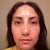 8 days after surgery you can tell that the right eye (your left) has a dent in the inner corner of my lower lid compared to the left eye (your right)