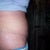 11-22-11 3 weeks post op ~ still really swollen ~ close-up of incision/scar ... I'm so happy with results
