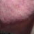 Day 1 after ePrime procedure(left cheek)